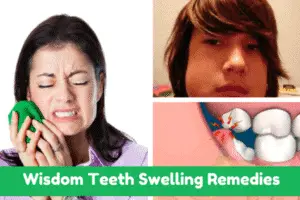 How to treat swelling from wisdom tooth extraction