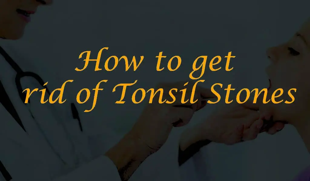 Best Tonsil Stone Removal guide, how to get rid of tonsil stone